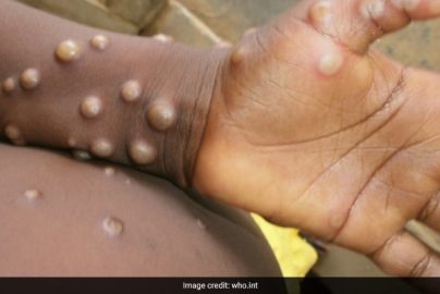 monkeypox-ndtv-com-who-int-2022-truth