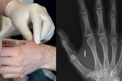 rfid-chip-hand-medicalfuturist-com-2022-truth